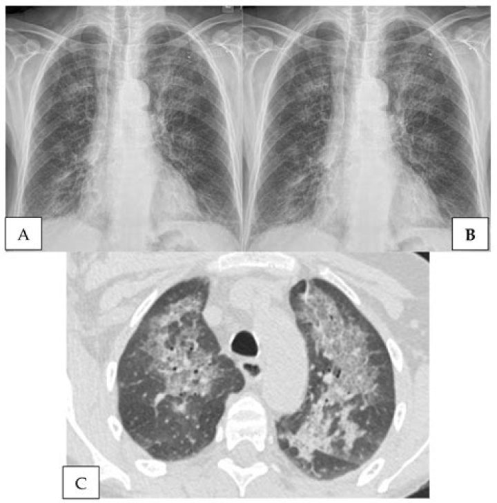 How long does it take to treat PCP pneumonia?