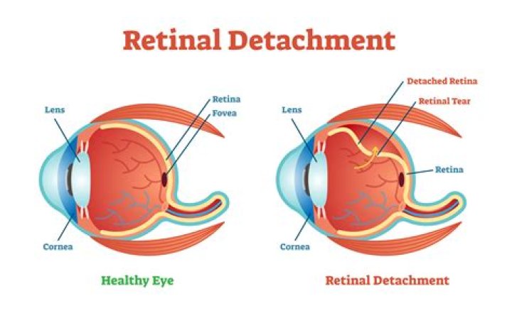 How long does retinal tear take to heal?