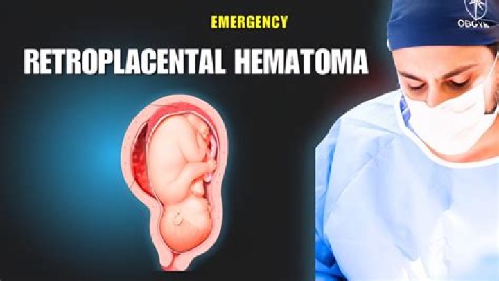 What is a Retroplacental hematoma?