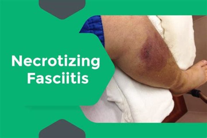 What is the CPT code for necrotizing fasciitis?