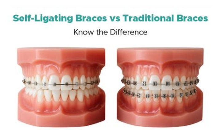 Why do some doctors prefer self-ligating brackets?